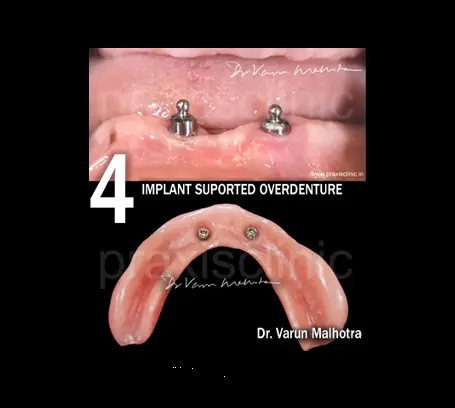Implant-supported overdenture for loose denture rehabilitation — full mouth rehabilitation Mumbai India PRAXIS Dental Dr Varun Malhotra